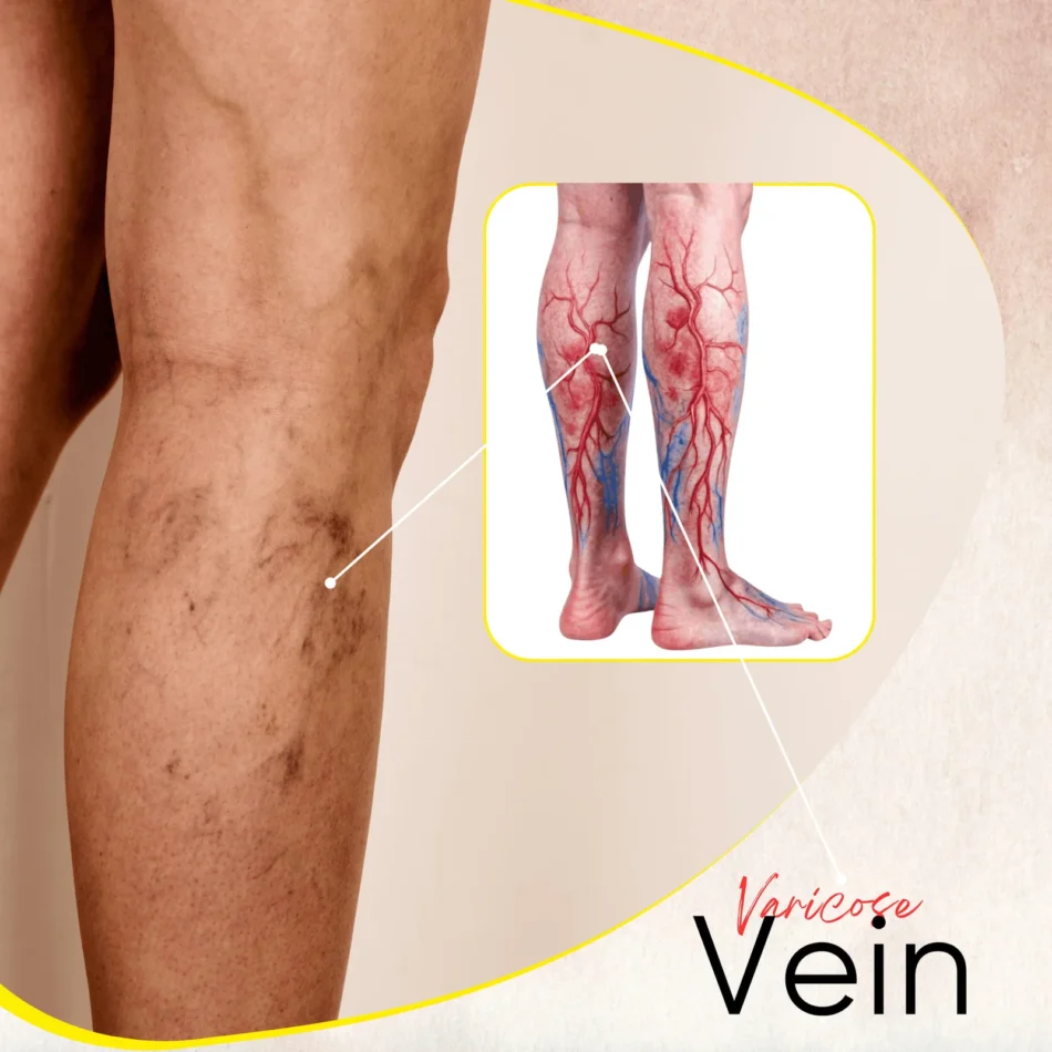 varicose-veins