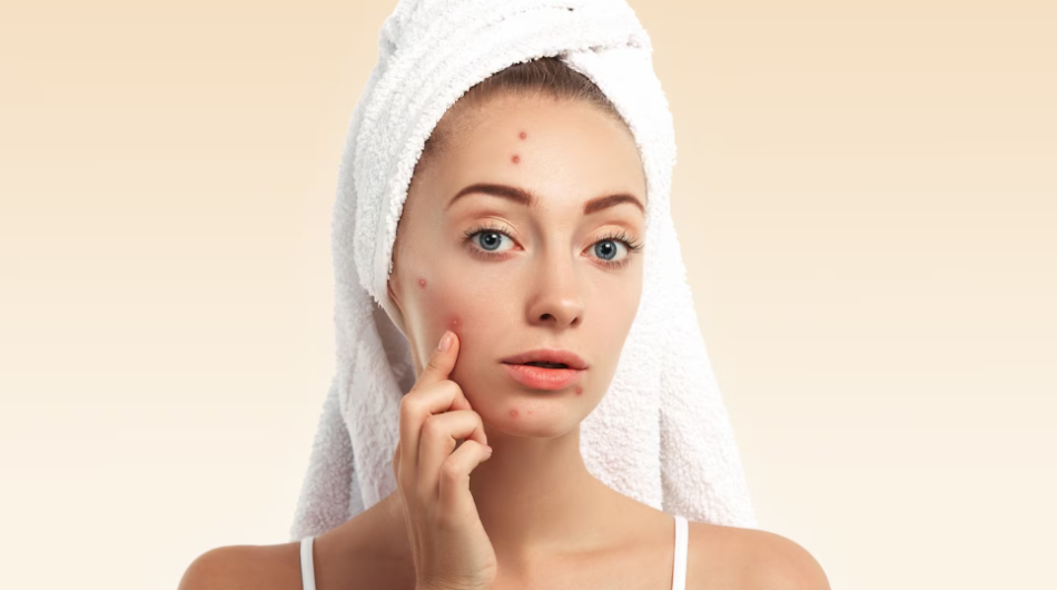 10-tips-para-mawala-ang-pimples