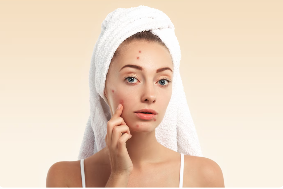 10 Tips Para Mawala ang Pimples: Practical na Gabay para sa Mas Malinis na Balat