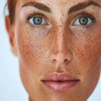 sunspots-treatment-fort-collins