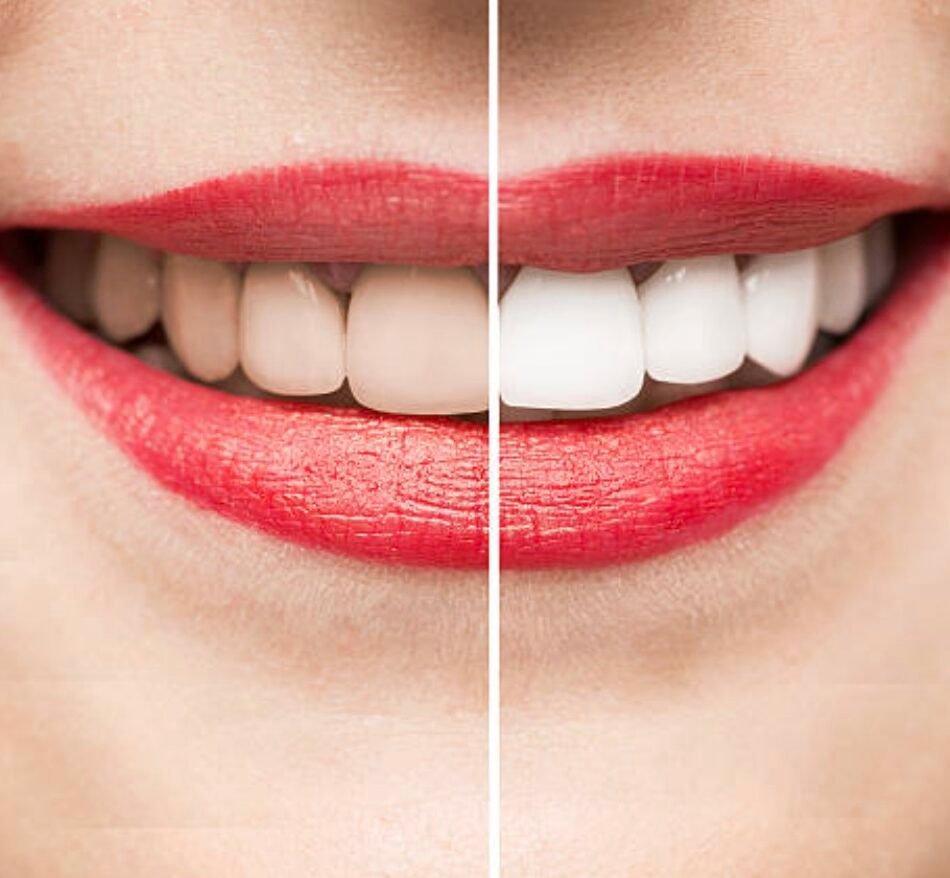 Teeth-Whitening-in-Mount-Roskill-Auckland